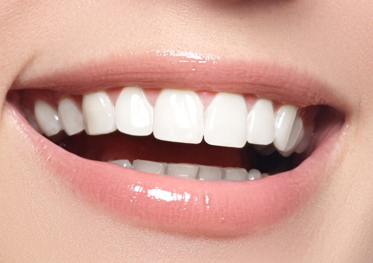 Professional Teeth Whitening in Bend OR Area